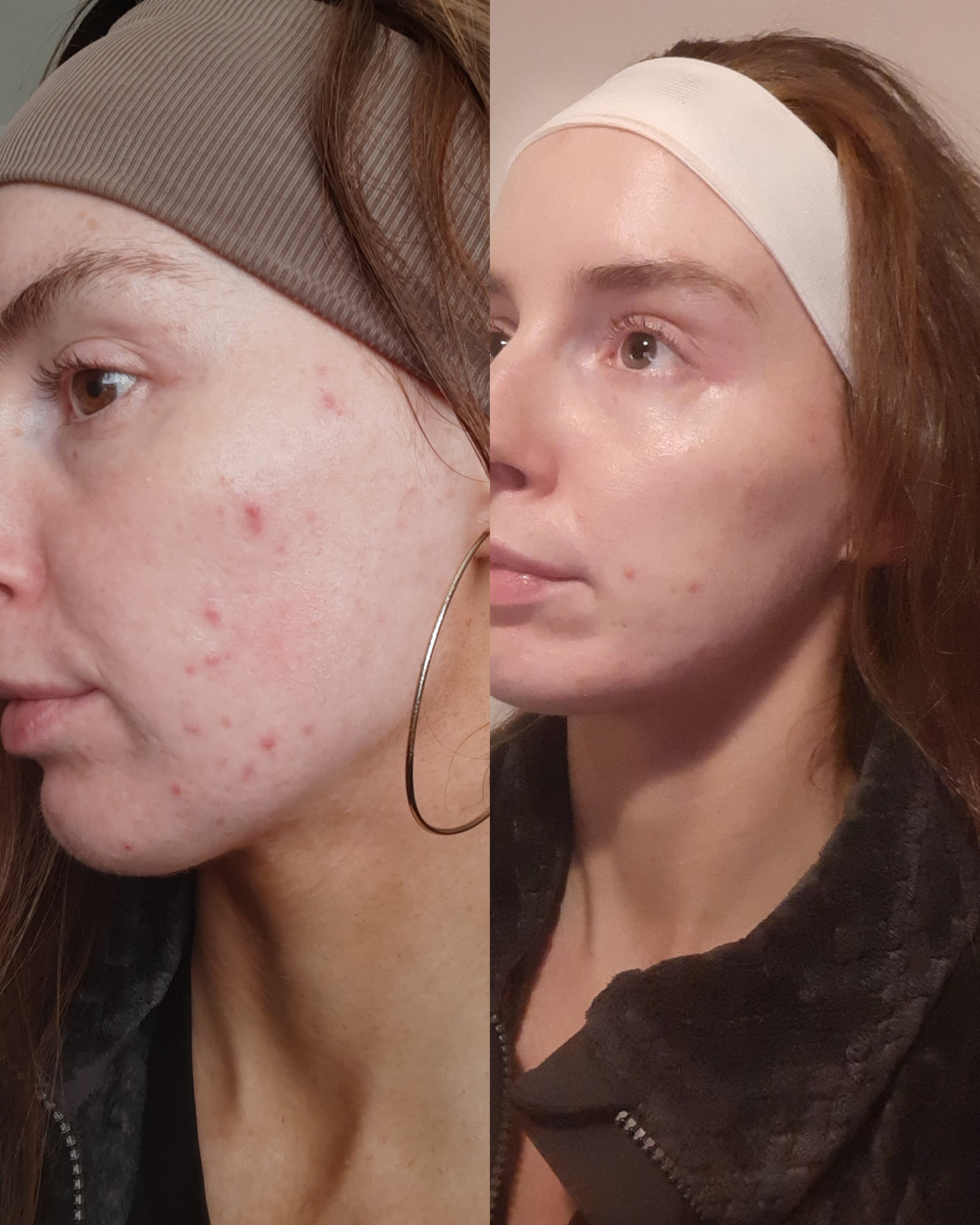 Before and after comparison of a person wearing a headband, showing skin with and without visible blemishes.